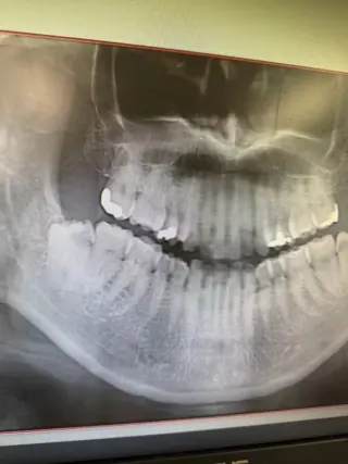 こんにちは！長津田おさまる歯科クリニックです✨

久しぶりに時間がかかった抜歯になってしまいました、、💦
冷静さを見失わずに精進します！今日もお疲れ様でございます。
患者様もお疲れ様でございます。腫れないことを願ってます。

#長津田おさまる歯科クリニック
#親知らずの抜歯
#難抜歯
#歯医者さんの日常
#歯科医師の独り言
#長津田
#横浜市緑区
#歯科恐怖症
#お疲れ様でした
#冷静沈着